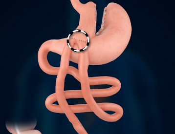One Anastomosis Gastric Bypass (Mini Gastric Bypass)